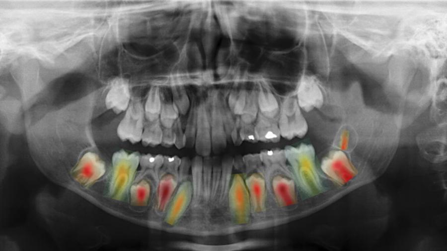 Unha das rexións anatómicas máis relevantes usadas neste proceso é a cavidade oral, xa que contén certas estruturas moi útiles, como os dentes e a mandíbula Unha das rexións anatómicas máis relevantes usadas neste proceso é a cavidade oral, xa que contén certas estruturas moi útiles, como os dentes e a mandíbula